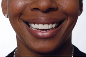 Snap-On-Smile after picture.