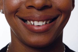 Snap-On-Smile before picture.
