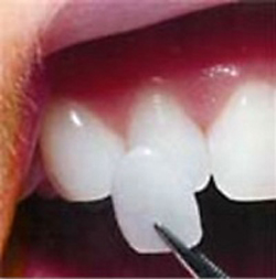 Photo of a porcelain veneer, which cannot be whitened, held against a natural tooth for Lowell, MA cosmetic dentist Dr. Szarek