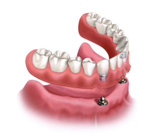 Diagram of snap-on dentures which are secured by dental implants, for information on stabilizing your dentures from the office of Lowell, MA dentist Dr. Michael Szarek.