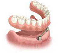 Diagram of a dental implant bar placed in the bone with a denture hovering over it and ready to be secured to the implants.