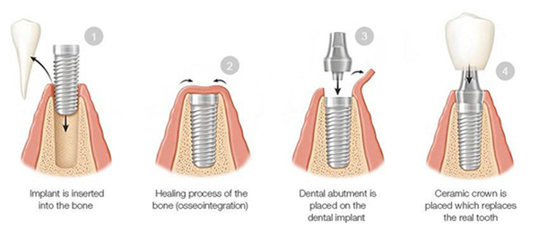 Diagram of dental implant phases, including 1) implant insertion in bone, 2) healing process, 3) abutment attachment, 4) crown attachment.