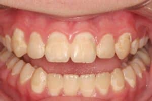 Dental bonding before photo of mottled, yellow, and uneven teeth that were restored by Lowell, MA accredited cosmetic dentist Dr. Szarek.