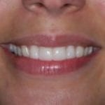 Close-up smile photo after a patient received porcelain veneers from Michael Szarek, DMD of Lowell, MA.