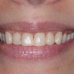 Close-up smile photo before a patient received porcelain veneers from Michael Szarek, DMD of Lowell, MA.