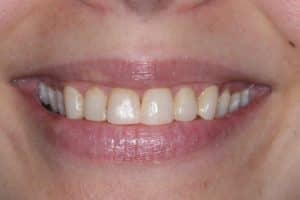 Close-up smile photo before a patient received porcelain veneers from Michael Szarek, DMD of Lowell, MA.