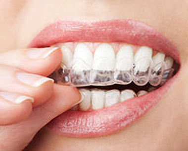 Photo of a woman's mouch with custom teeth whitening trays being placed on her teeth; from Lowell MA accredited cosmetic dentist Michael Szarek, DMD.