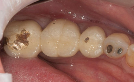 Lower molar teeth with metal showing through the crowns