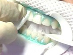 Teeth bleaching gel applied to teeeth