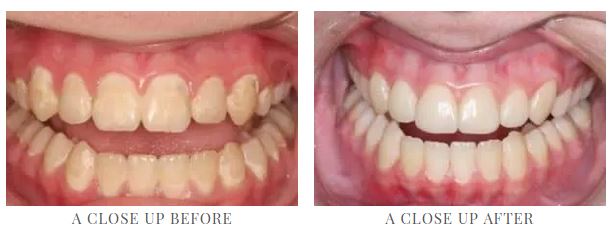 Before-and-afte composite bonding photos from Lowell, MA dentist Dr. Szarek