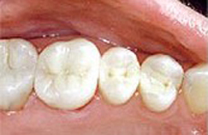 Molar teeth with composite fillings