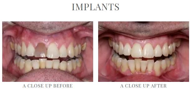 Before and after dental implant photos from Lowell, MA dentist Dr. Szarek