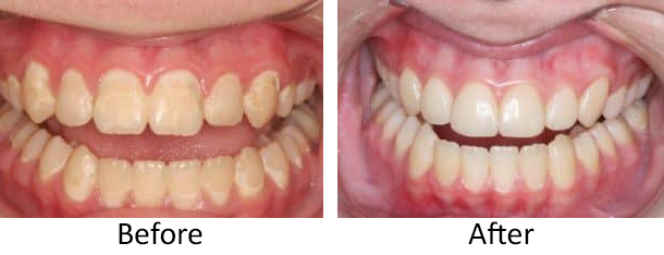 Before and after dental bonding photos from Lowell, MA cosmetic dentist Dr. Michael Szarek