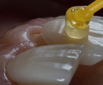 A porcelain veneer being bonded to a tooth