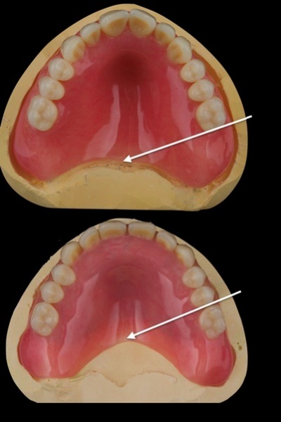 Upper: The denture extends to the vibrating line. Lower: The denture is farther from the vibrating line to minimize gagging.