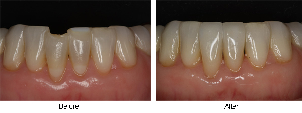 Before and after chipped lower incisor tooth restoration with porcelain veneers