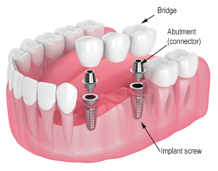 Dental implant bridge